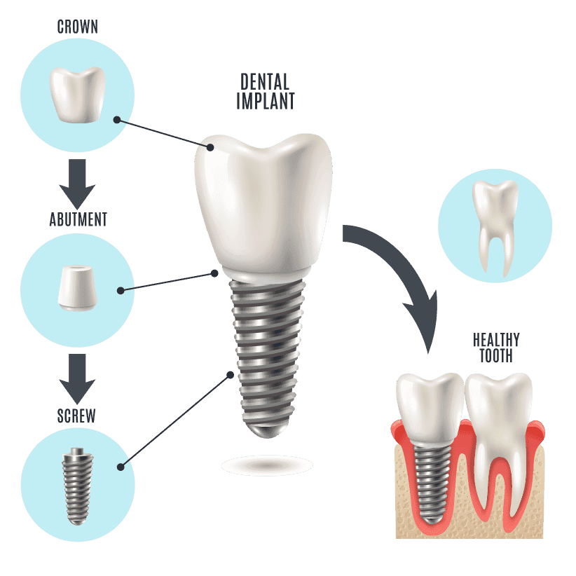 Three stages of a dental implant restoration