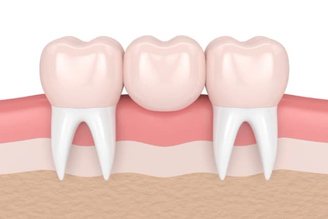 Custom Crowns and Bridges