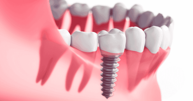 Dental Implants