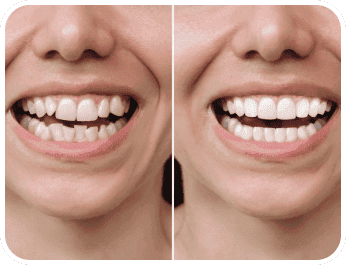 Minimal prep veneers before and after