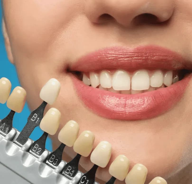 Minimal-Prep Veneers
