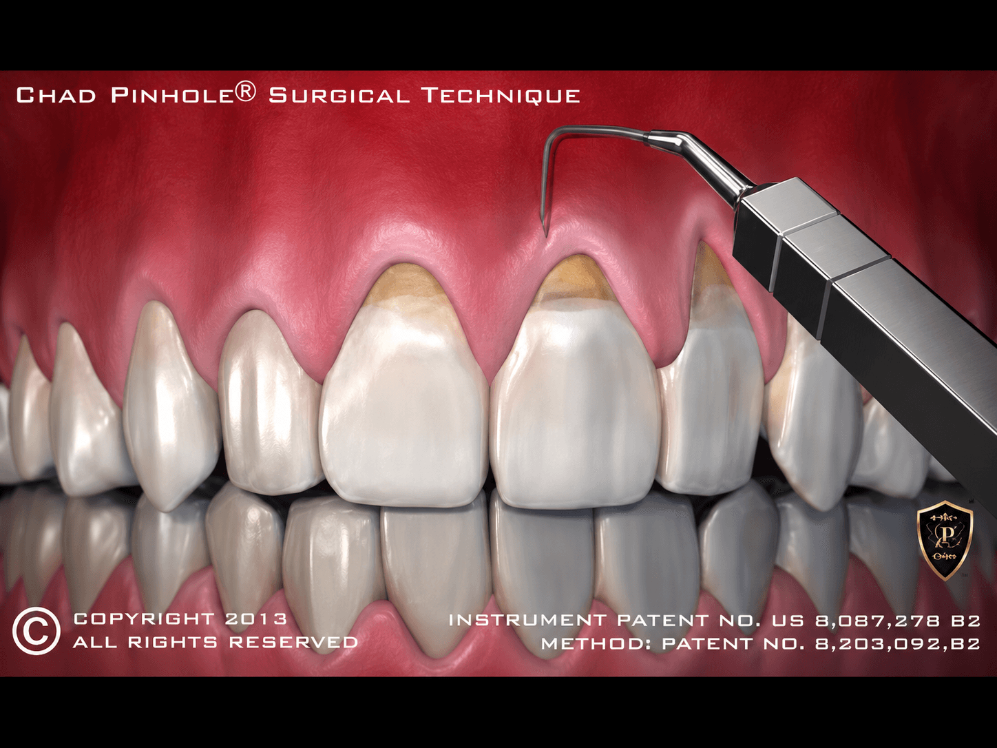 Pinhole® Surgical Technique