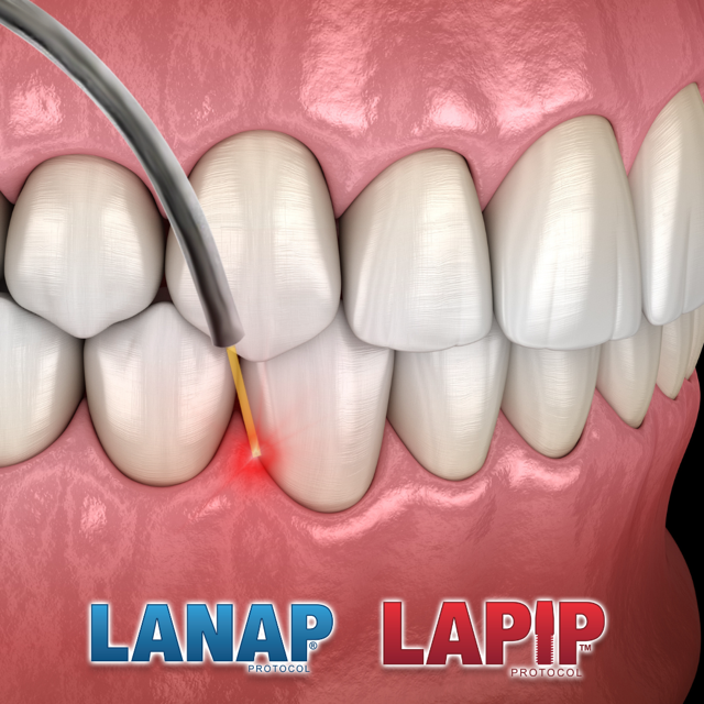 LANAP laser-assisted new attachment procedure