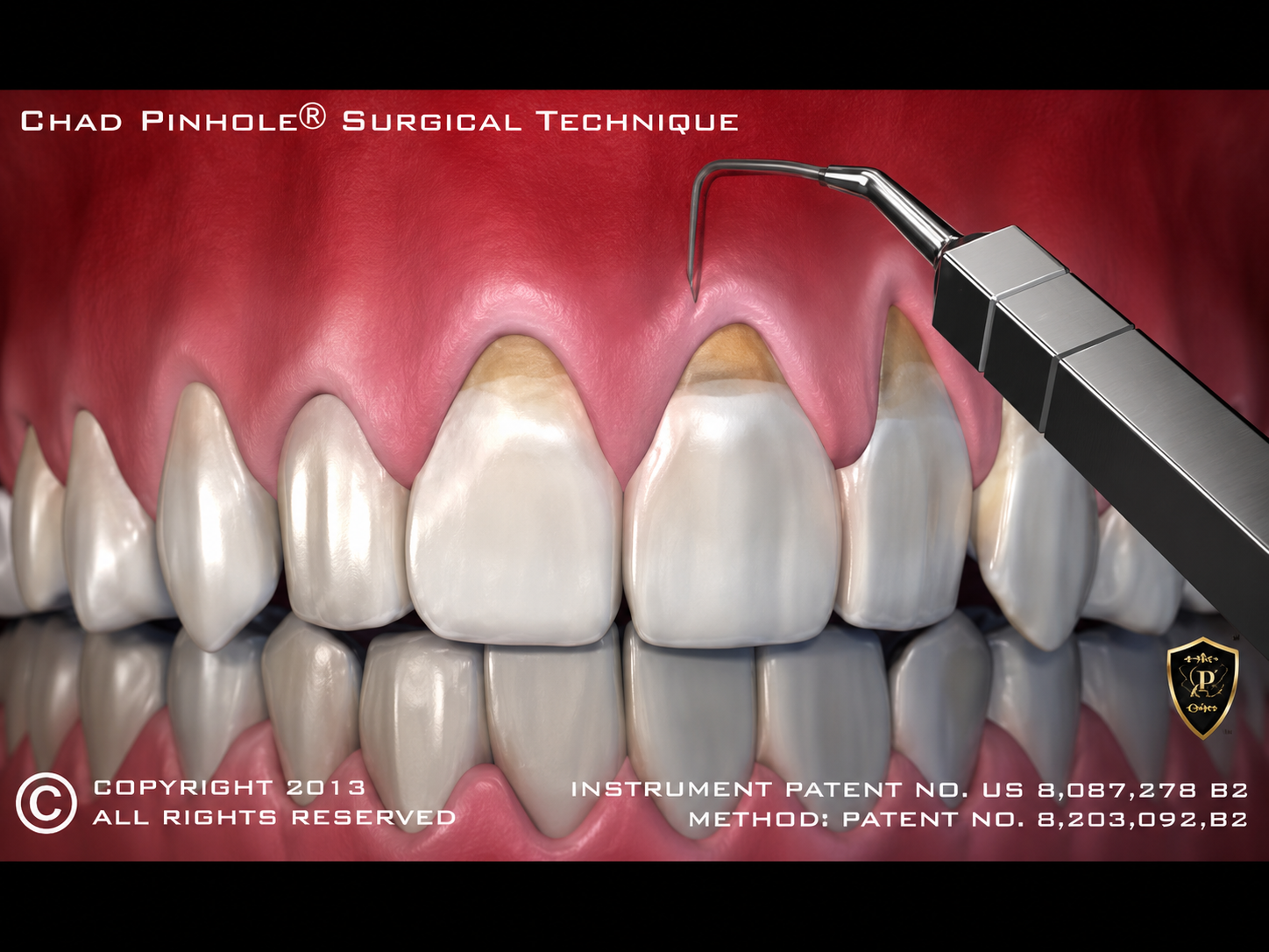 Pinhole® Surgical Technique