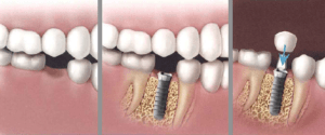 "Affordable Best Dental Implant Dentist in Upper East Side, NYC"