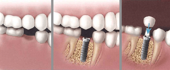 "Affordable Best Dental Implant Dentist in Upper East Side, NYC"