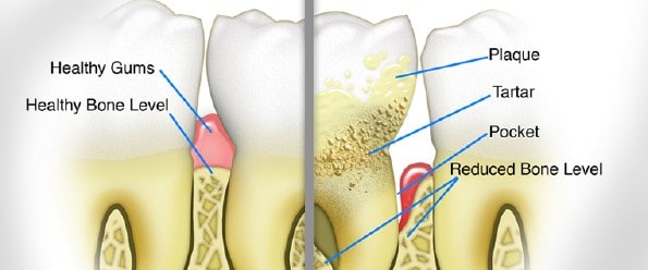 "Best Periodontal Gum Disease Specialists in Manhattan,NYC"