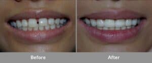 "Best Dentist for Porcelain Veneers in NYC"